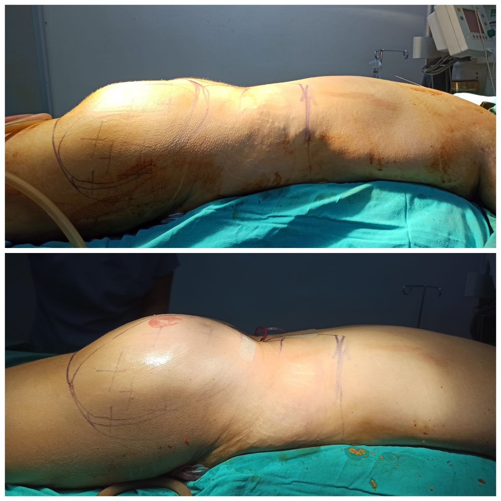 BBL Turkey - Before and After Transformation