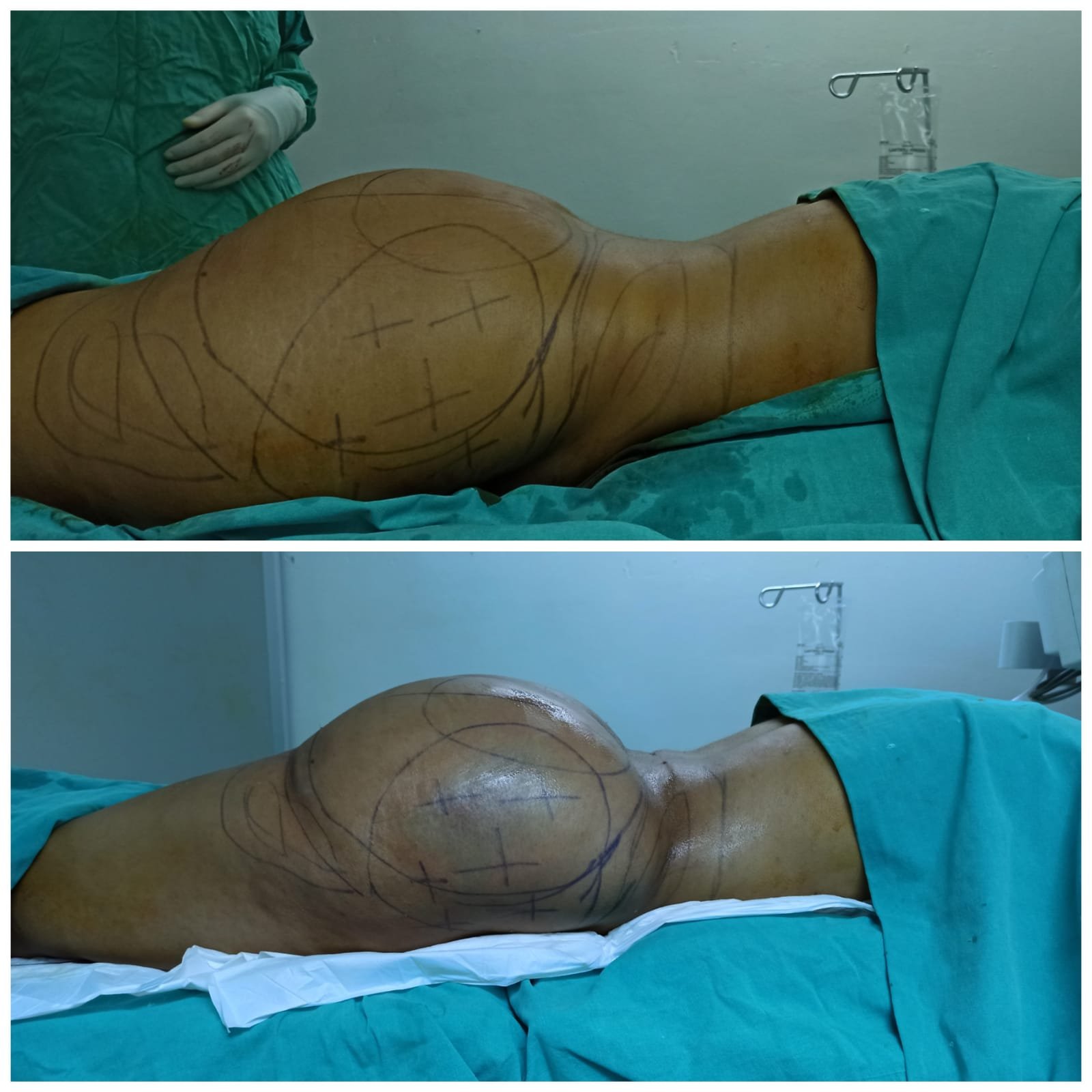 BBL Turkey - Before and After Transformation