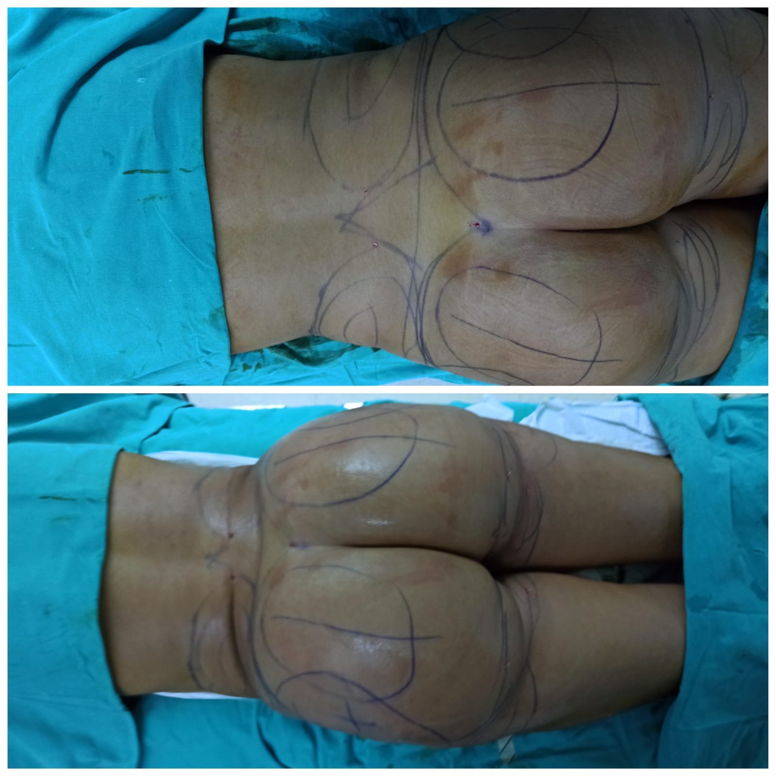 BBL Turkey - Before and After Transformation