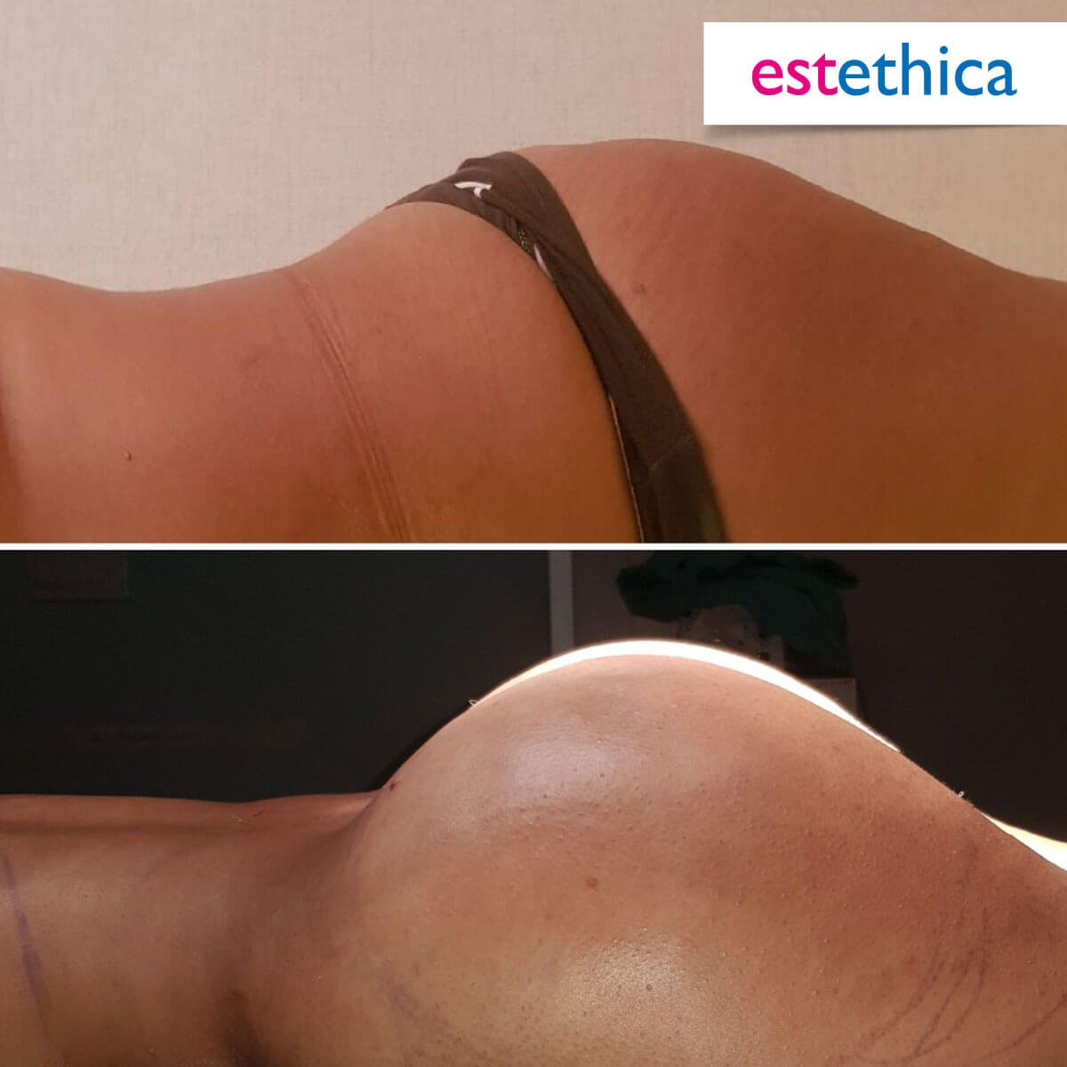 BBL Turkey - Before and After Transformation