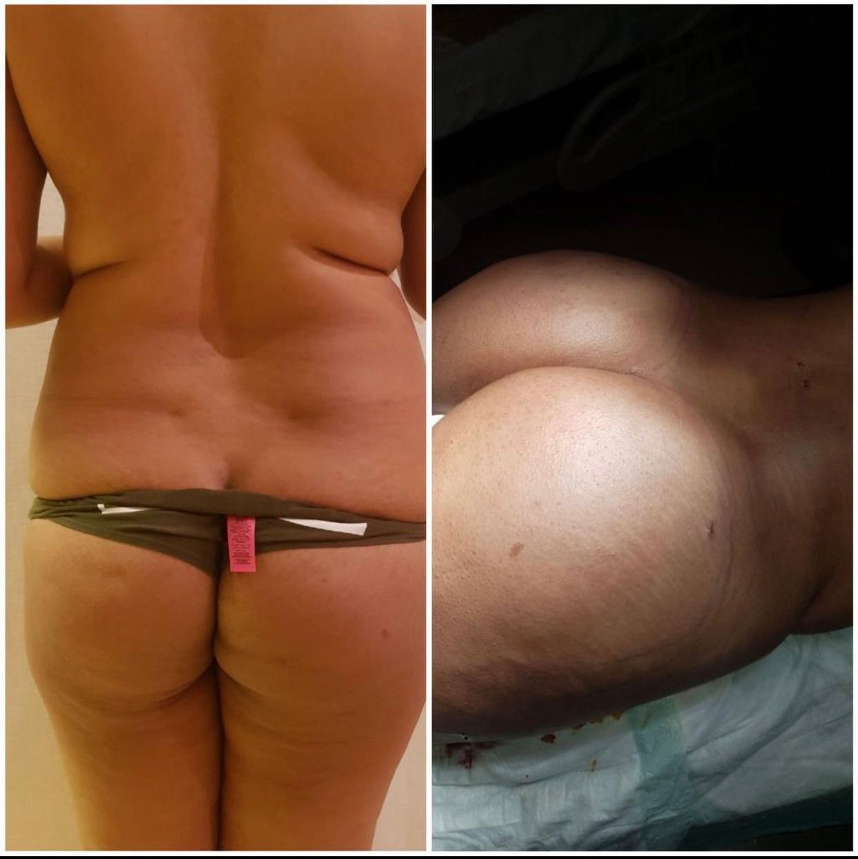 BBL Turkey - Before and After Transformation