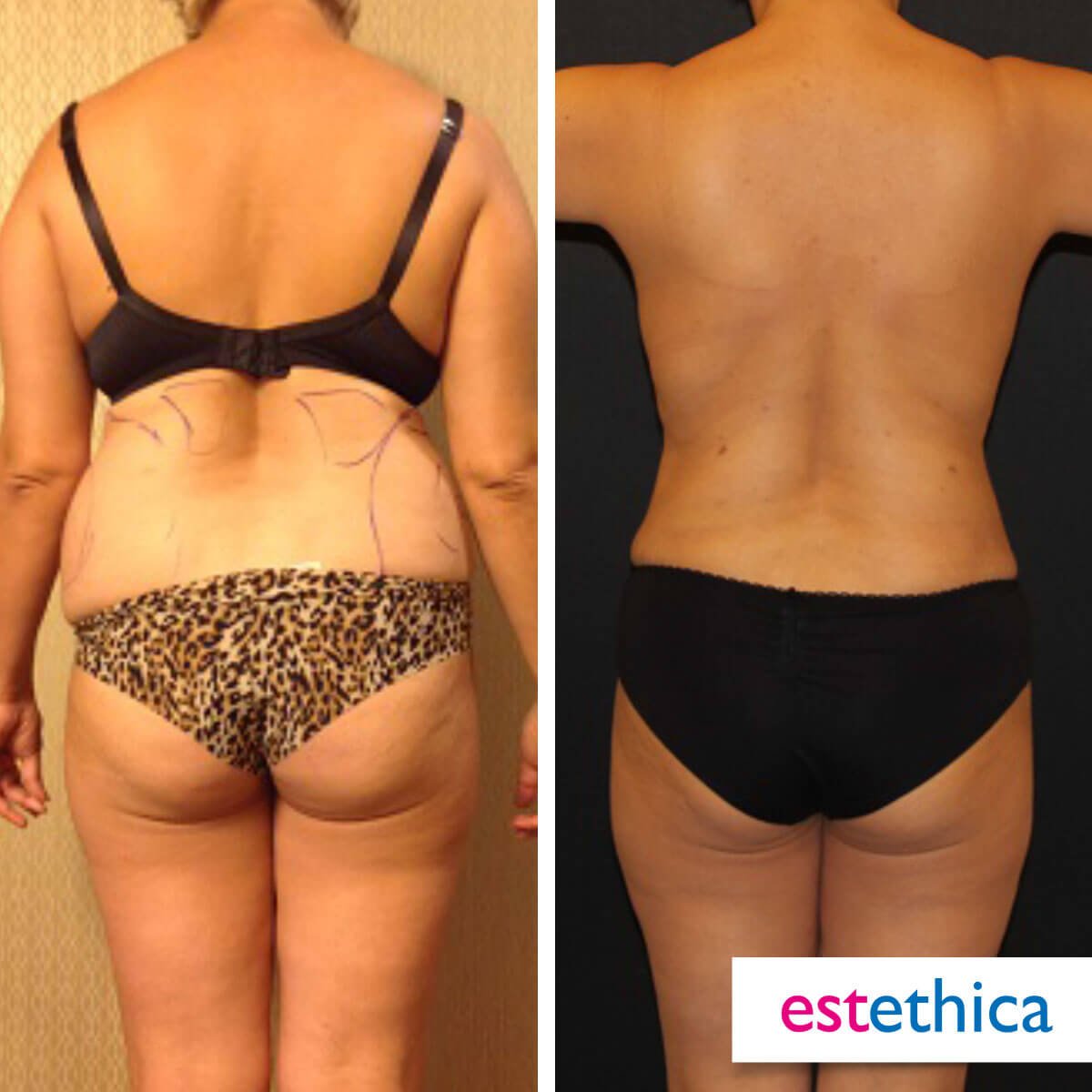 Mommy Makeover Before After 4