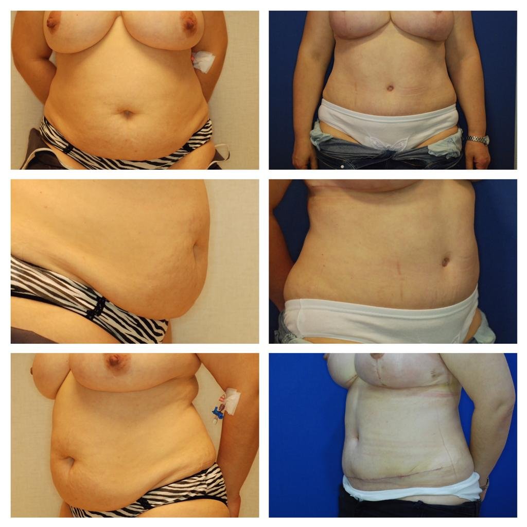 Mommy Makeover Before After 5