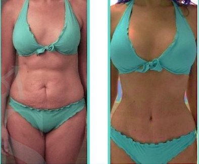 Mommy Makeover Before After 2