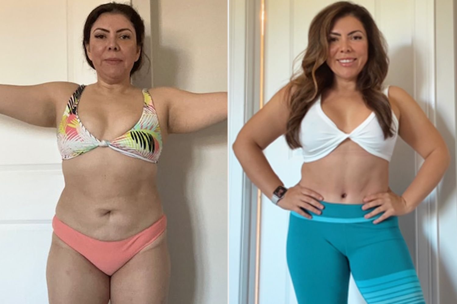 Mommy Makeover Before After 3