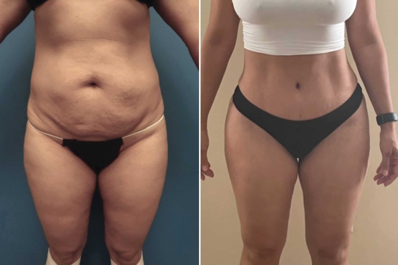 Mommy Makeover Before After 1