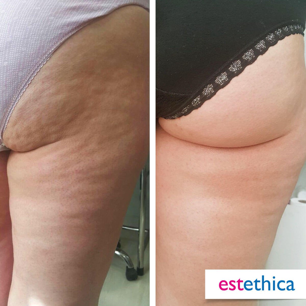 Mommy Makeover Before After 6